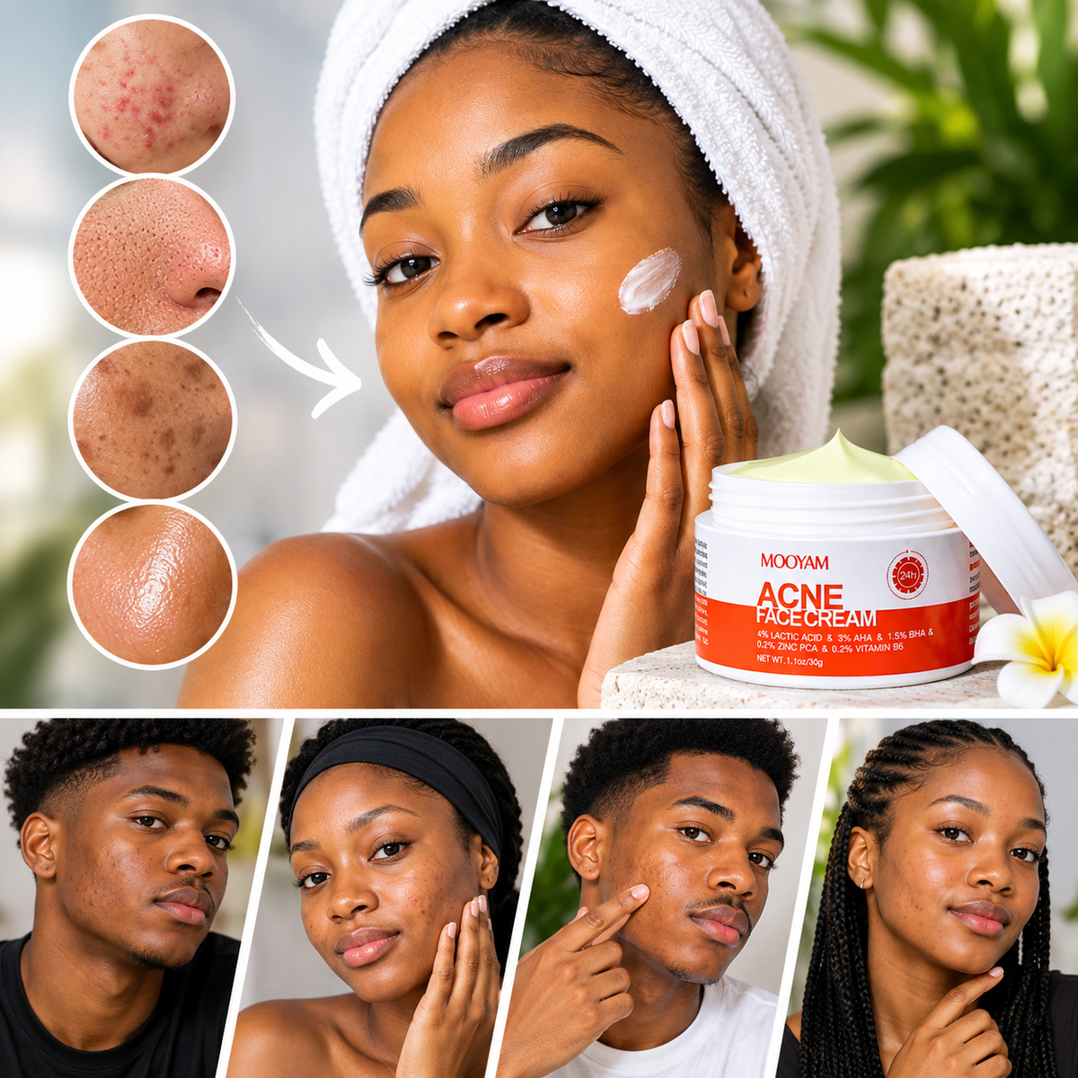 MOOYAM Acne Face Cream – Crème visage peaux à imperfections 30 g